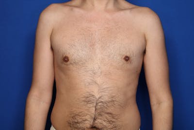 Gynecomastia (Male Breast Reduction) Before & After Gallery - Patient 239296 - Image 2