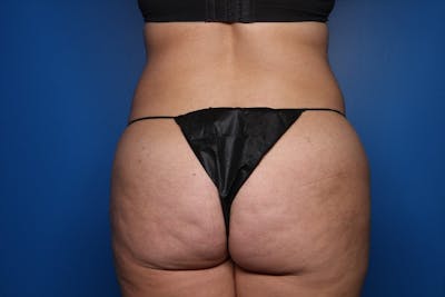 Liposuction Before & After Gallery - Patient 359805 - Image 1