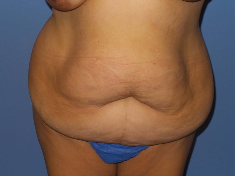 Breast Lift Before & After Gallery - Patient 312190 - Image 7