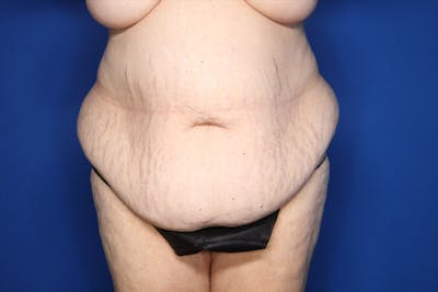 Tummy Tuck Before & After Gallery - Patient 228415 - Image 1