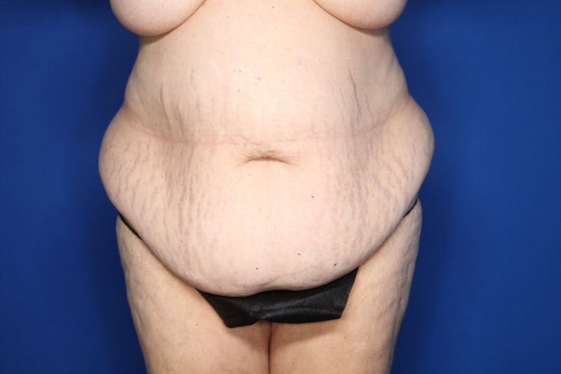 Tummy Tuck Before & After Gallery - Patient 228415 - Image 1