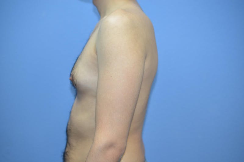 Gynecomastia (Male Breast Reduction) Before & After Gallery - Patient 239296 - Image 3