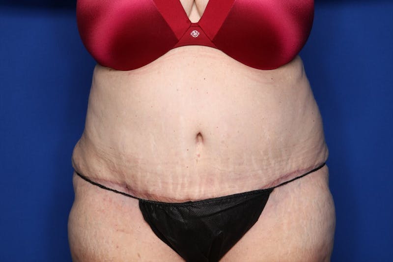 Tummy Tuck Before & After Gallery - Patient 228415 - Image 2