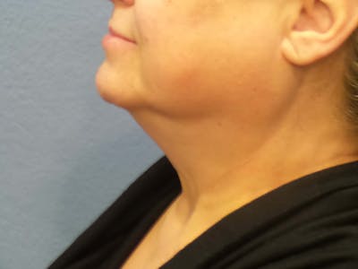 FaceTite Before and After Before & After Gallery - Patient 108170 - Image 1