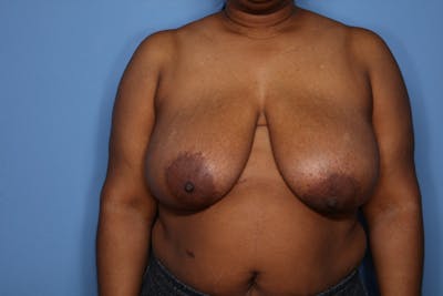 Breast Reduction Before & After Gallery - Patient 221445 - Image 1