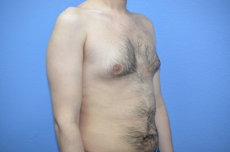 Gynecomastia (Male Breast Reduction) Before & After Gallery - Patient 239296 - Image 5