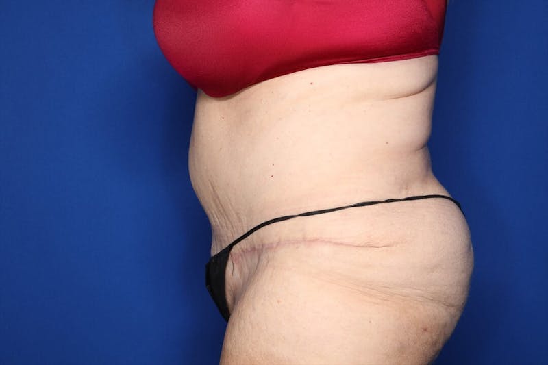Tummy Tuck Before & After Gallery - Patient 228415 - Image 4