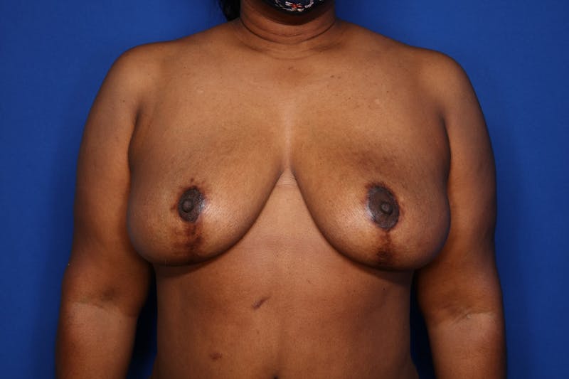 Breast Reduction Before & After Gallery - Patient 221445 - Image 2