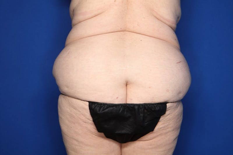 Tummy Tuck Before & After Gallery - Patient 228415 - Image 5