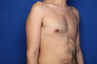 Gynecomastia (Male Breast Reduction) Before & After Gallery - Patient 239296 - Image 6