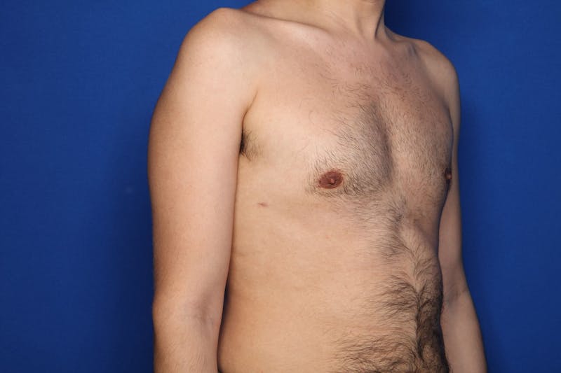 Gynecomastia (Male Breast Reduction) Before & After Gallery - Patient 239296 - Image 6