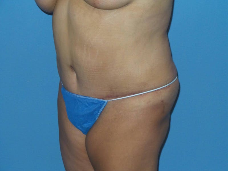 Breast Lift Before & After Gallery - Patient 312190 - Image 10