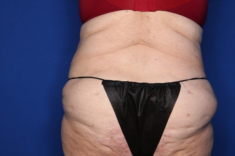 Tummy Tuck Before & After Gallery - Patient 228415 - Image 6