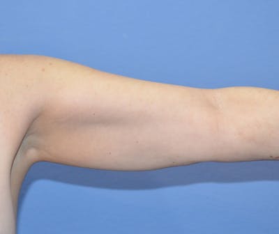 BodyTite™ Before & After Gallery - Patient 328273 - Image 1