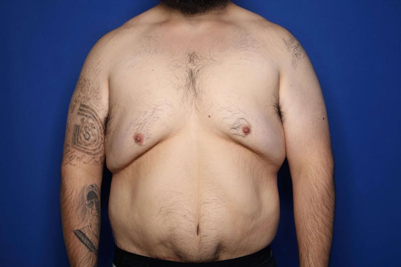 Gynecomastia (Male Breast Reduction) Before & After Gallery - Patient 210092 - Image 1