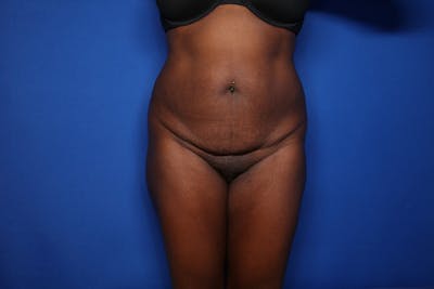 Tummy Tuck Before & After Gallery - Patient 166194 - Image 1