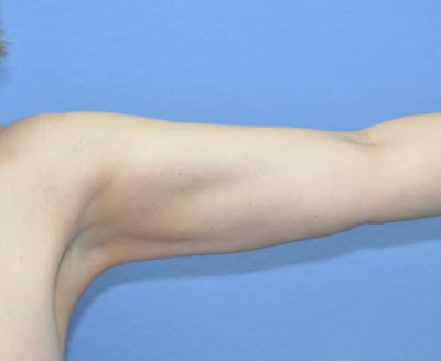 BodyTite™ Before & After Gallery - Patient 328273 - Image 2