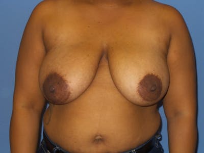 Breast Reduction Before & After Gallery - Patient 223610 - Image 1