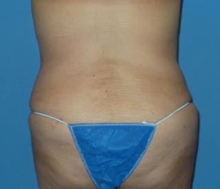 Breast Lift Before & After Gallery - Patient 312190 - Image 12