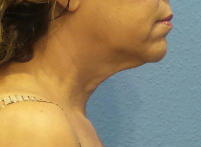 FaceTite Before and After Before & After Gallery - Patient 100142 - Image 1