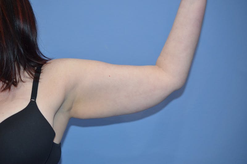 BodyTite™ Before and After Before & After Gallery - Patient 148876 - Image 1