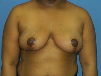 Breast Reduction Before & After Gallery - Patient 223610 - Image 2