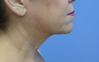 FaceTite Before and After Before & After Gallery - Patient 100142 - Image 2