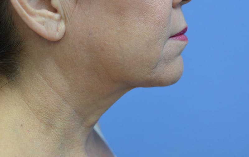 FaceTite™ Before & After Gallery - Patient 100142 - Image 2
