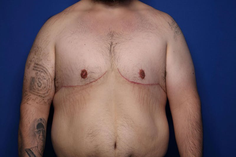 Gynecomastia (Male Breast Reduction) Before & After Gallery - Patient 210092 - Image 2