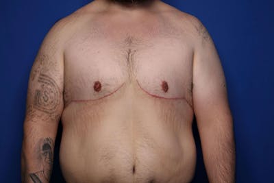 Gynecomastia (Male Breast Reduction) Before & After Gallery - Patient 210092 - Image 2