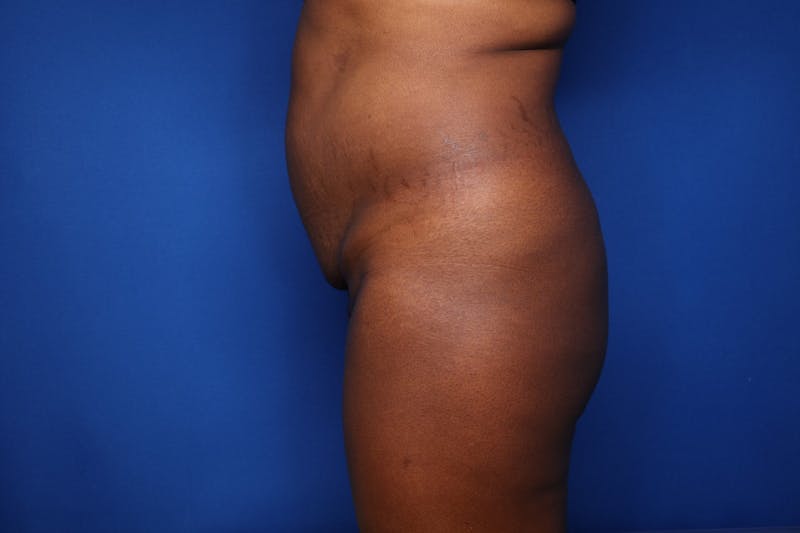 Tummy Tuck Before & After Gallery - Patient 166194 - Image 3