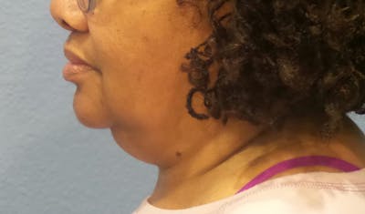 FaceTite Before and After Before & After Gallery - Patient 392877 - Image 1