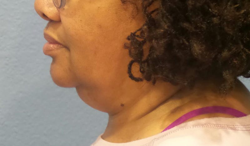 FaceTite Before and After Before & After Gallery - Patient 392877 - Image 1