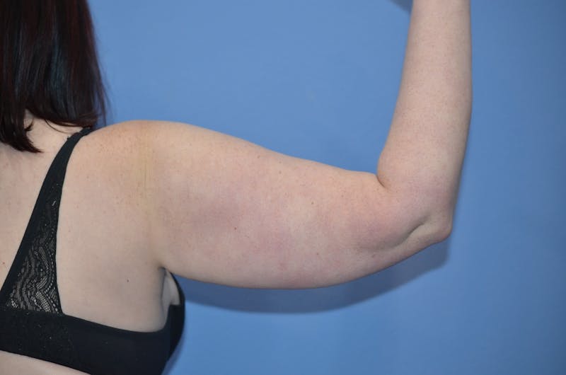 BodyTite™ Before and After Before & After Gallery - Patient 148876 - Image 3