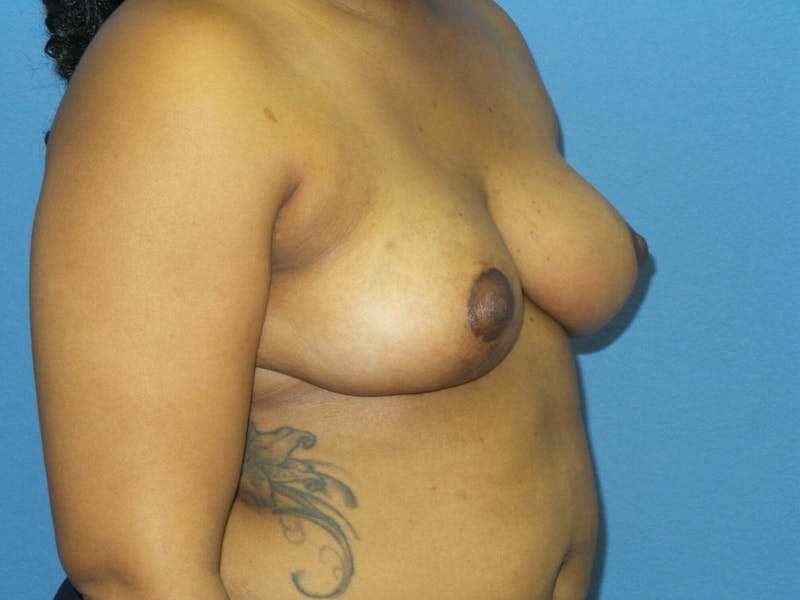 Breast Reduction Before & After Gallery - Patient 223610 - Image 4
