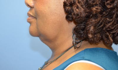 FaceTite Before and After Before & After Gallery - Patient 392877 - Image 2
