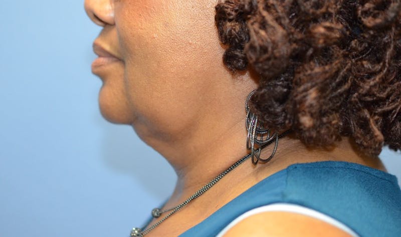 FaceTite Before and After Before & After Gallery - Patient 392877 - Image 2