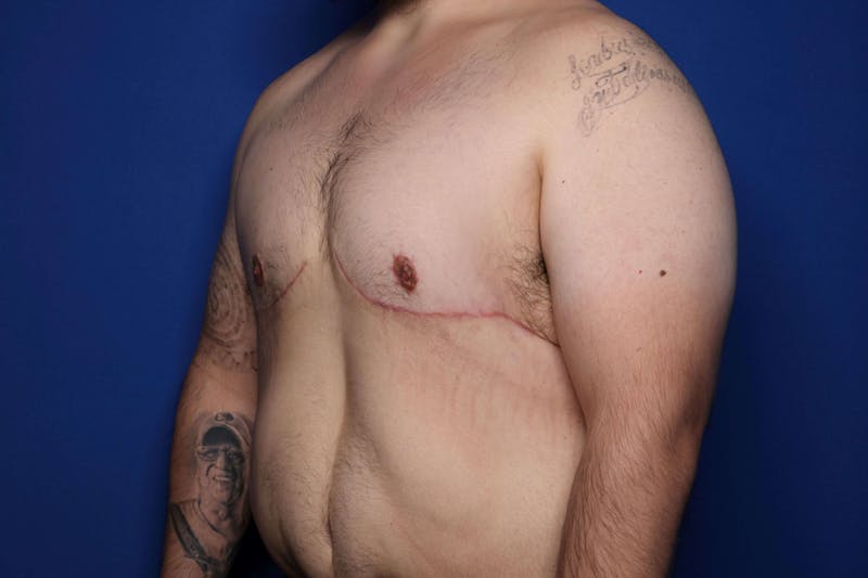 Gynecomastia (Male Breast Reduction) Before & After Gallery - Patient 210092 - Image 4