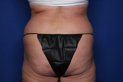 Liposuction Before & After Gallery - Patient 262555 - Image 1