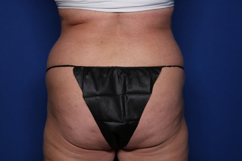 Liposuction Before & After Gallery - Patient 262555 - Image 1