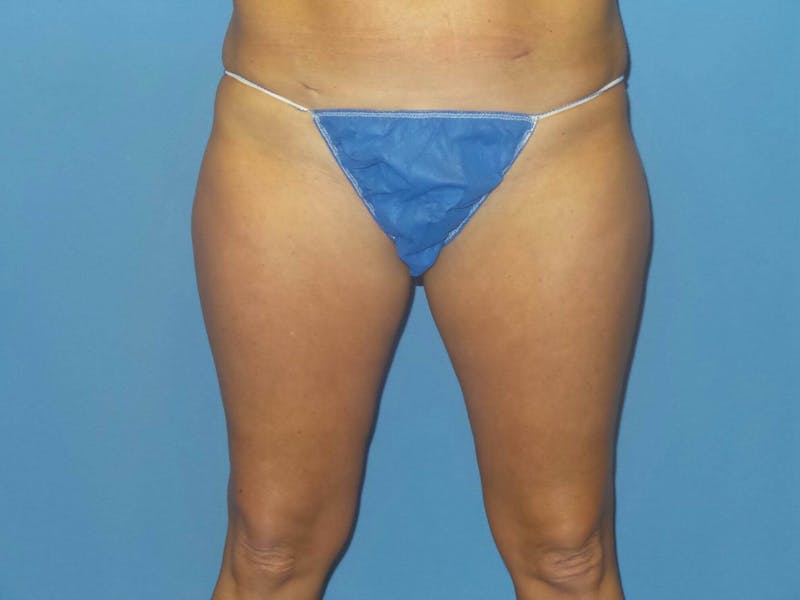 BodyTite™ Before and After Before & After Gallery - Patient 413114 - Image 1