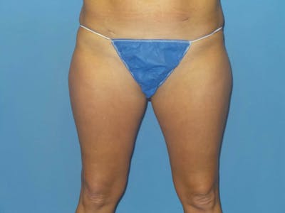BodyTite™ Before & After Gallery - Patient 413114 - Image 1
