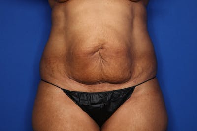 Tummy Tuck Before & After Gallery - Patient 346468 - Image 1