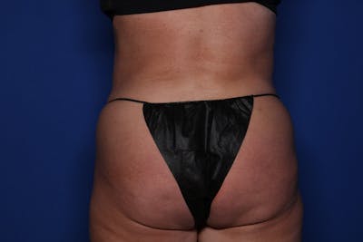 Liposuction Before & After Gallery - Patient 262555 - Image 2