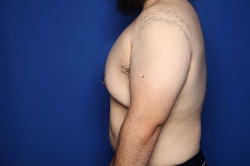 Gynecomastia (Male Breast Reduction) Before & After Gallery - Patient 210092 - Image 5