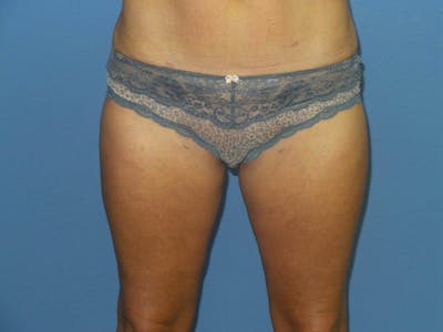 BodyTite™ Before and After Before & After Gallery - Patient 413114 - Image 2