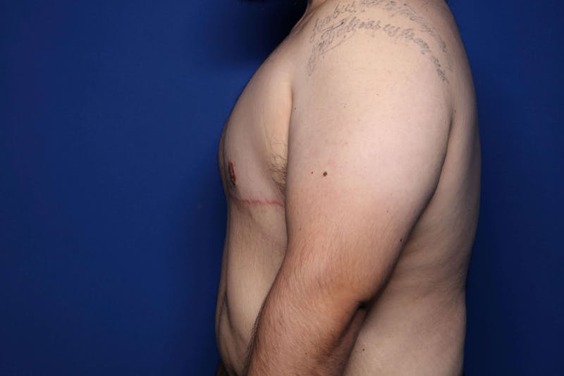 Gynecomastia (Male Breast Reduction) Before & After Gallery - Patient 210092 - Image 6
