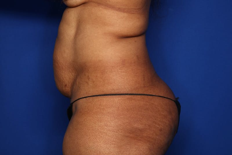 Tummy Tuck Before & After Gallery - Patient 346468 - Image 3
