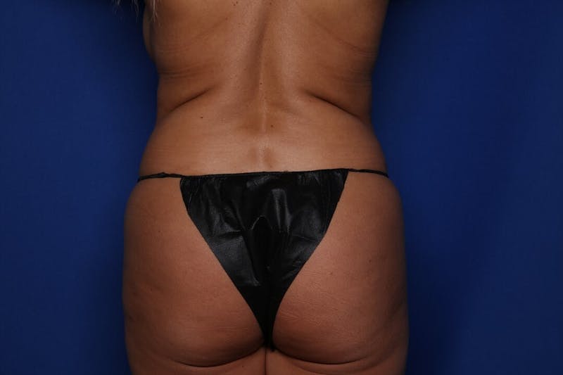 Liposuction Before & After Gallery - Patient 422977 - Image 3