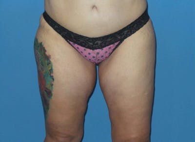 BodyTite™ Before & After Gallery - Patient 399054 - Image 1
